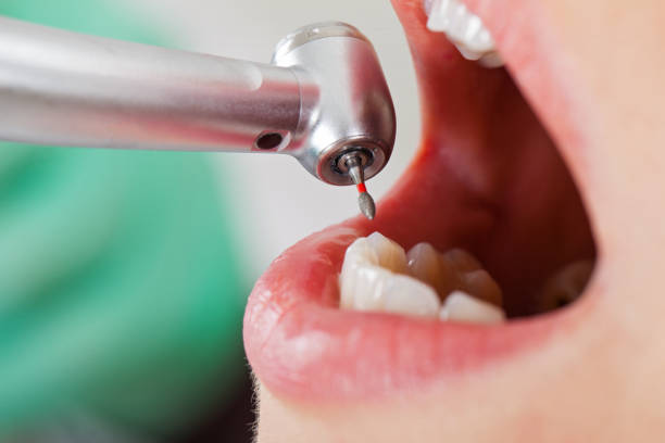 Best Emergency Tooth Extraction in Brawley, CA